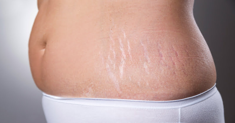 Tips for postpartum stretch marks