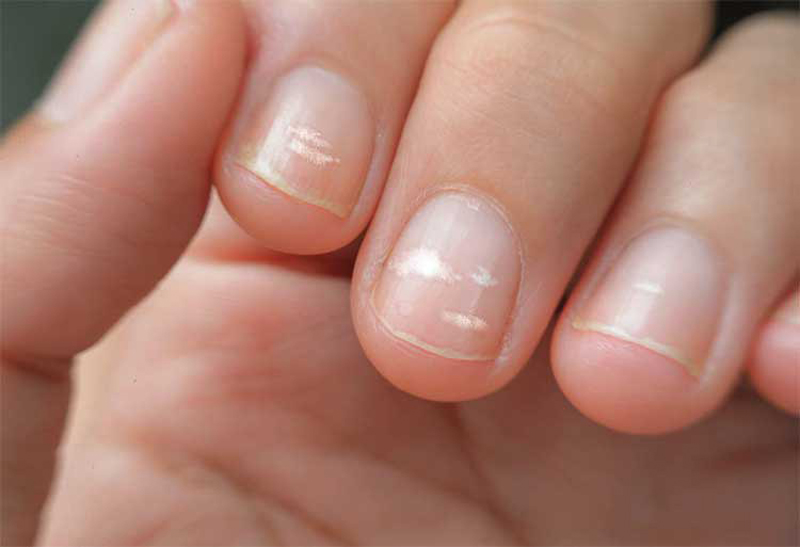 White spots on nails: