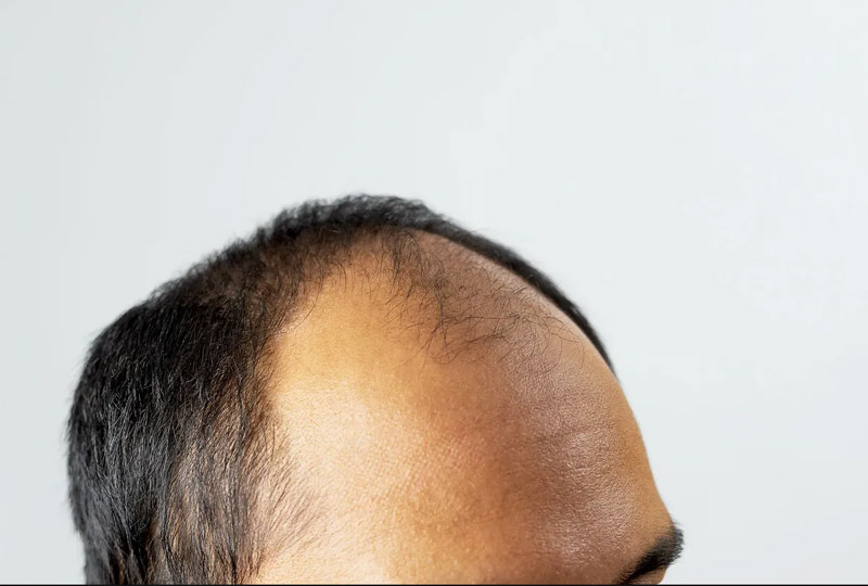 BALD HEAD hair growth tips 