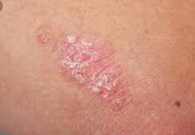 Paoriasis: Skin Problem To Check Perminantly Ayurvedic Medicine