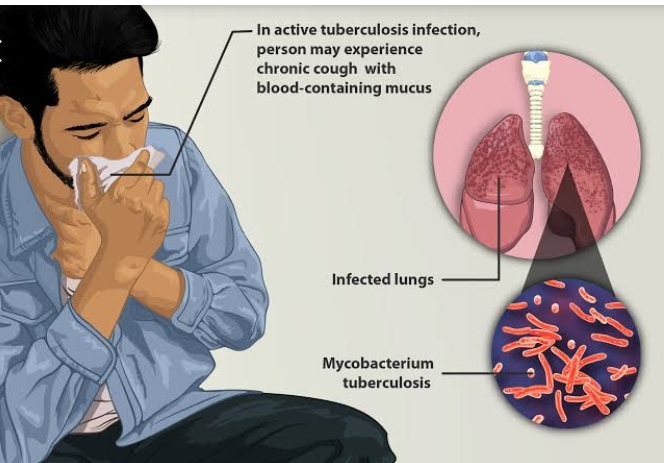 Tuberculosis: To Check this Food and juices 