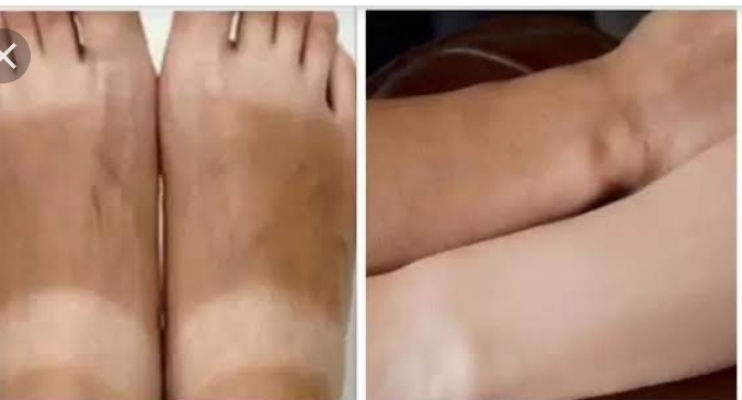 Sun Tan: Remove Instantly neck legs hands excellent home remedie