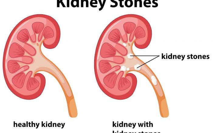 Kidney Stones: Reduce Kondapindi Aaku Juice