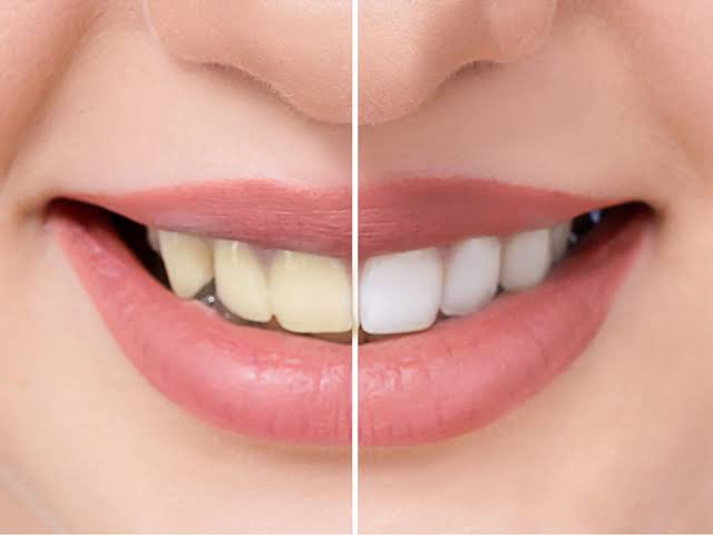 Sparkling White Teeth: home remedies excellent results
