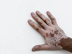 Ayurvedic Remedie For Vitiligo: Skin Problems