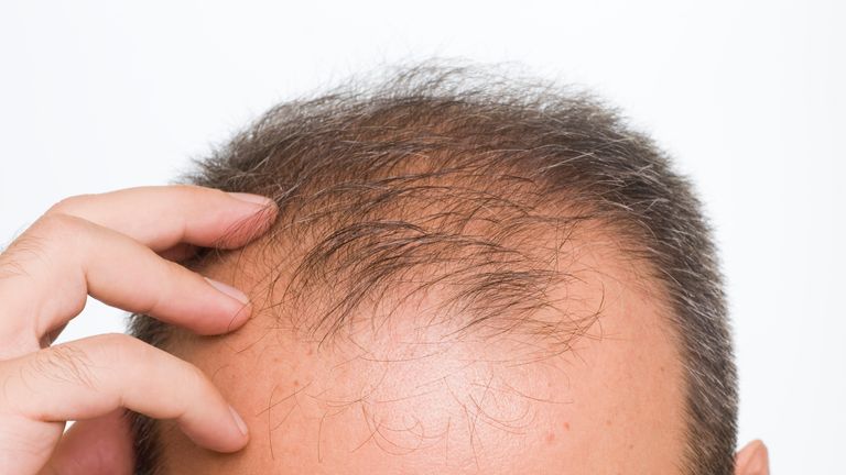 Bald Head: hair grows maha udaga tailam 