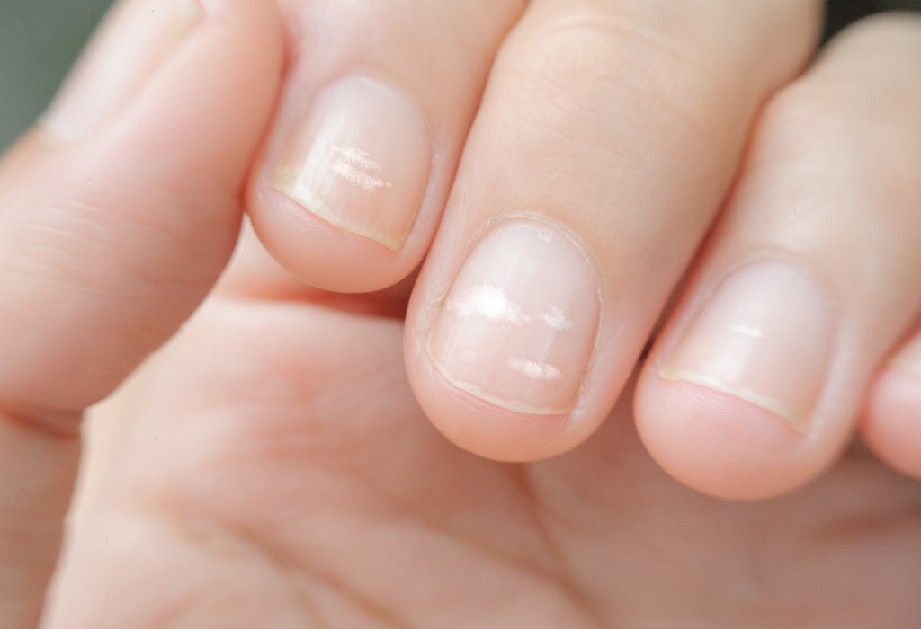White Spots:  On Nails See what happens