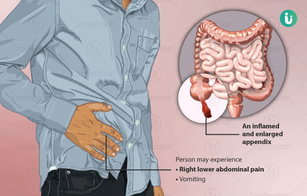 Appendicitics: symptoms and cure process