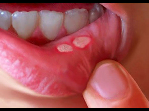 Home remedies For Mouth Ulcer: 