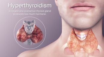 Hyperthyroidism: హైపర్ థైరాయిడిజం అంటే.. కనిపించే లక్షణాలు..!!