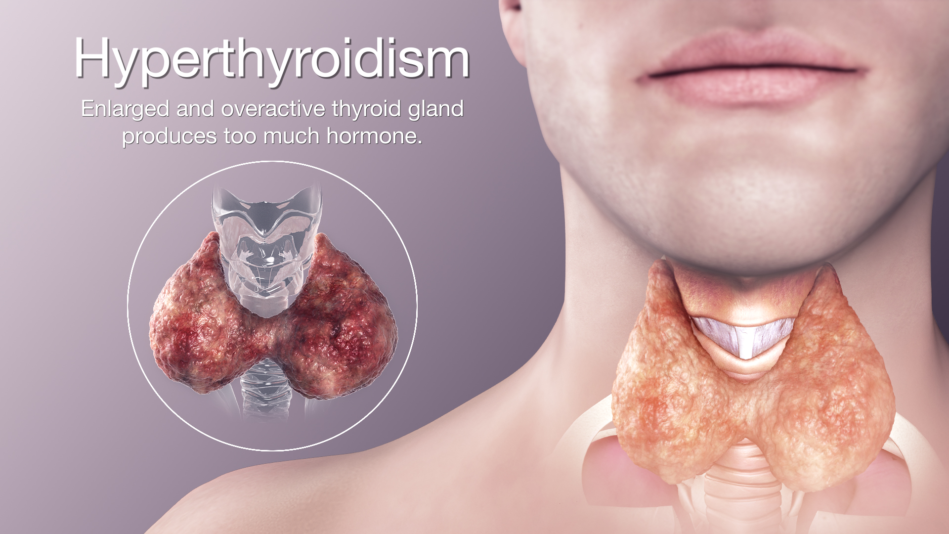 Hyperthyroidism: Symptoms and precautions