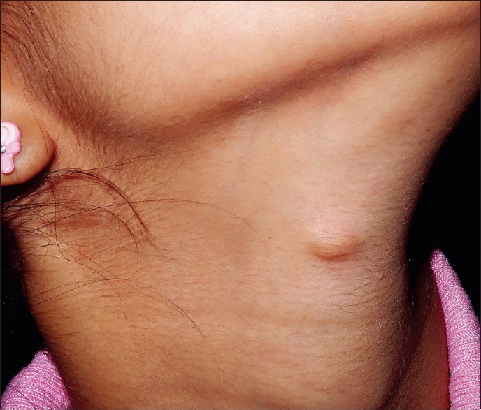 What Is Neck Abscess: it is injurious 