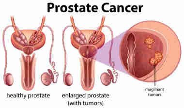 Prostate Cancer:  stages and symptoms 