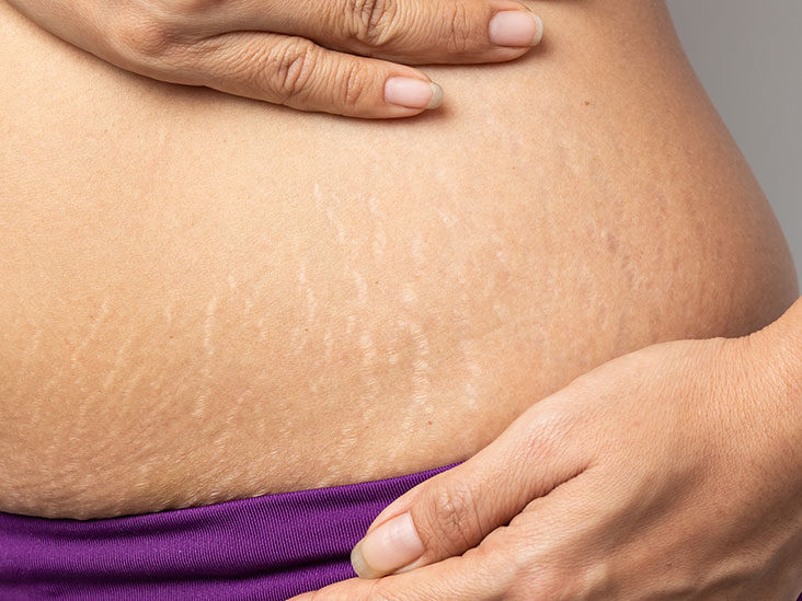 Excellent Home Remedies For Stretch Marks:  