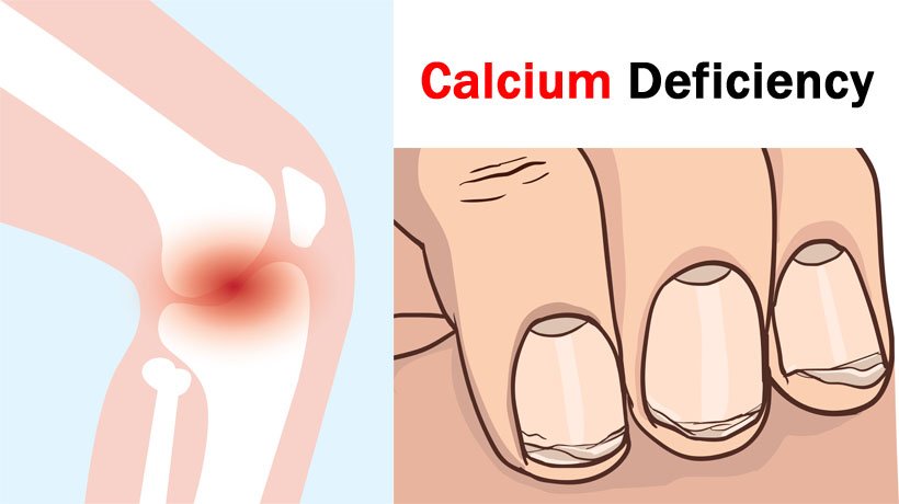 Calcium Deficiency: To Check With These Nuts