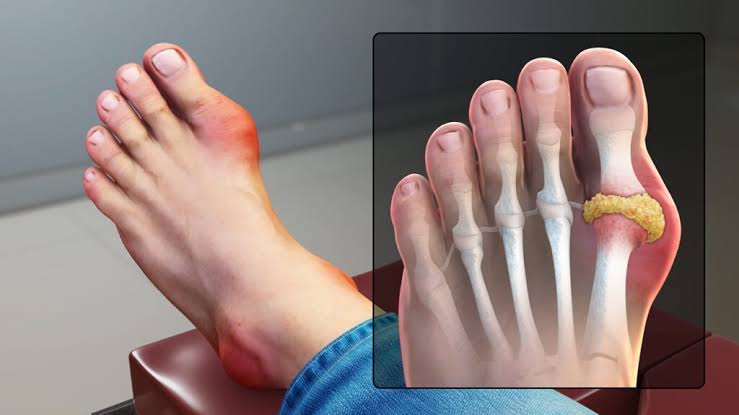 What is Gout: and their Symptoms 