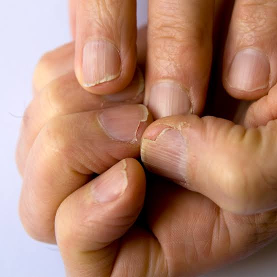 Nails: splitting Indicates On hypo Thyroidism 