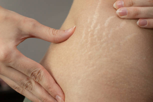 Excellent Home remides for Stretch Marks: 