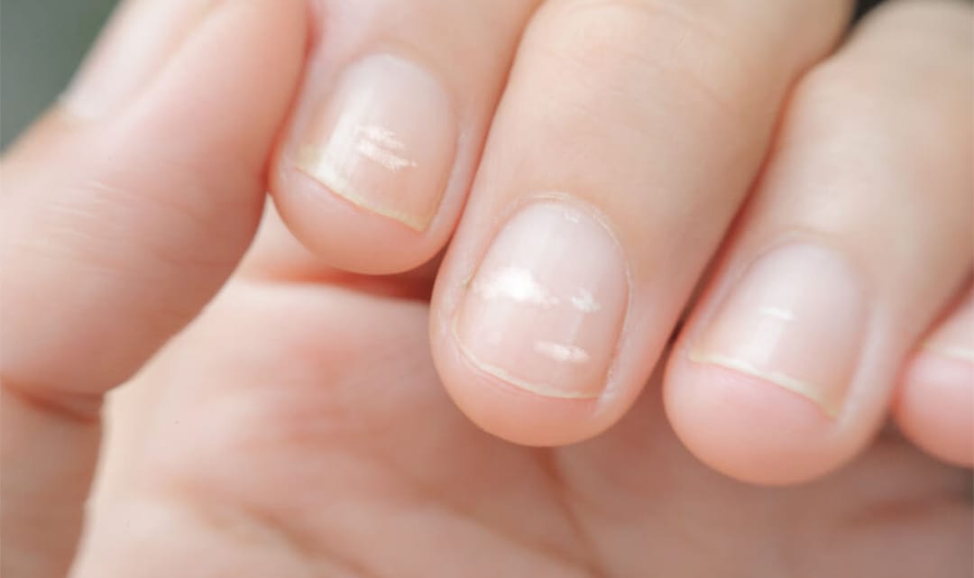 How to know your diseases based on fingernails .. ??