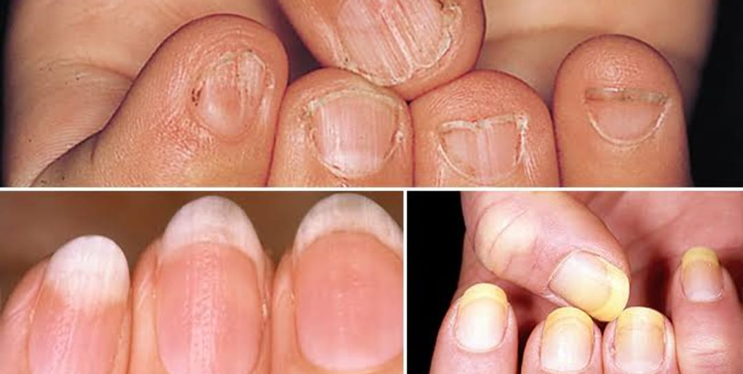 How to know your diseases based on fingernails .. ??