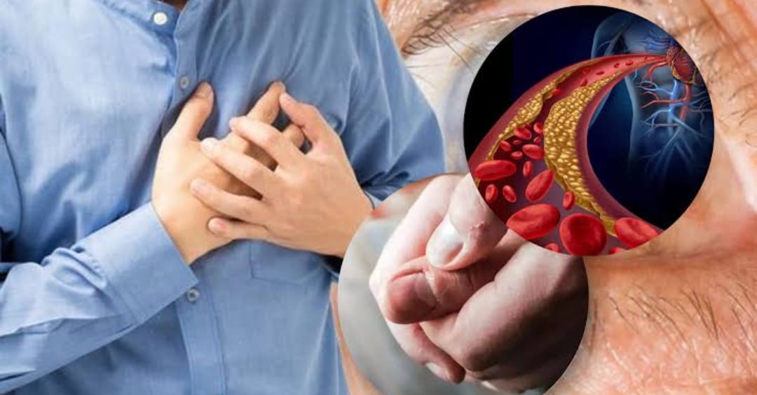 If you have these symptoms, it means that you have bad cholesterol in your body ..!