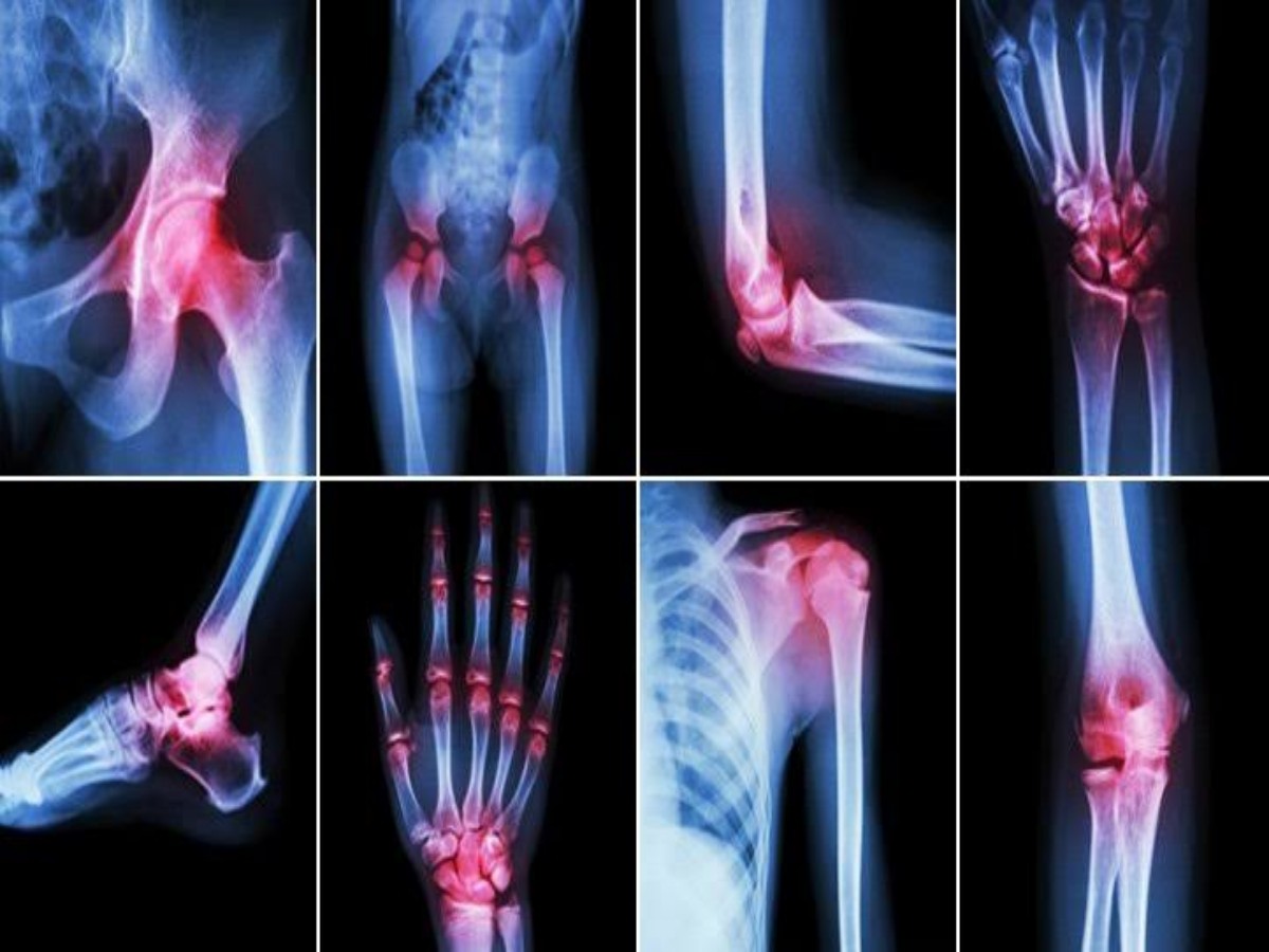 World Arthritis Day 2022: Above image depicts typical arthritis problems