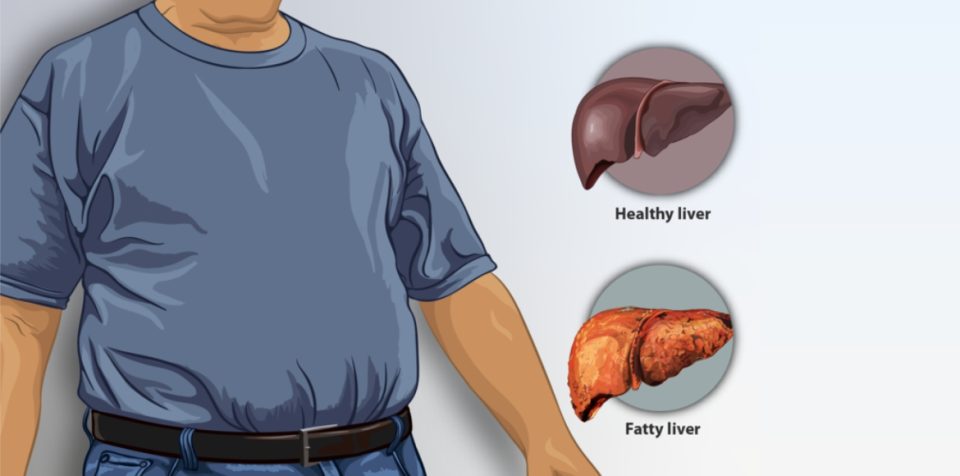 Fatty Liver Disease How to identify Fatty Liver Disease and Preventive Measures