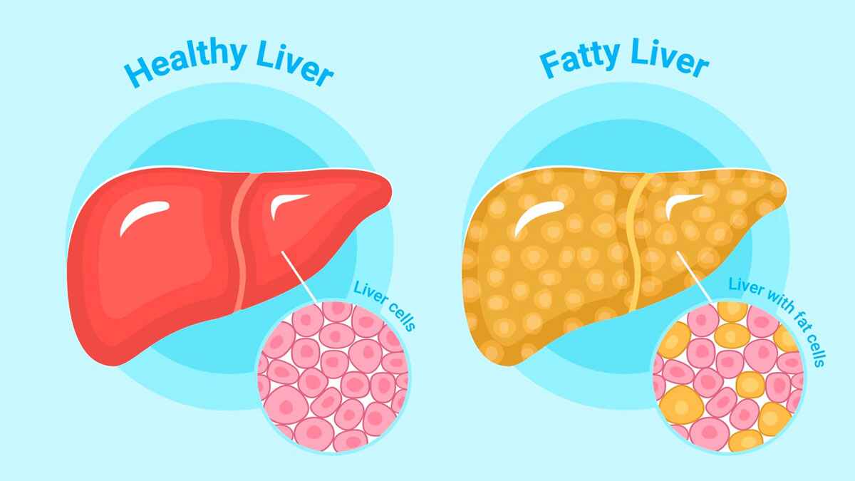 Fatty Liver Disease How to identify Fatty Liver Disease and Preventive Measures