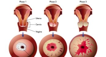 Cervical Cancer: మీలో ఈ 5 లక్షణాలు ఉన్నాయా.. అయితే గర్భాశయ క్యాన్సర్ ఏర్పడే అవకాశం ఉంది..!