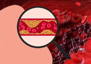 These are the main causes of blood clots in the body